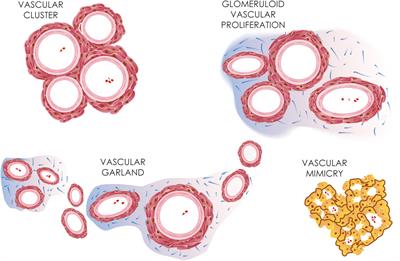 Blood-Brain Barrier Alterations and Edema Formation in Different Brain Mass Lesions